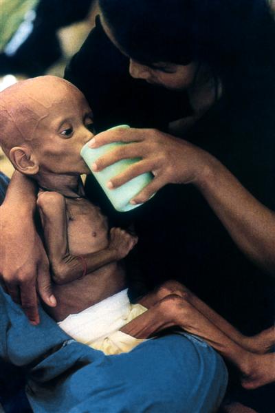 Niño afectado de grave desnutrición