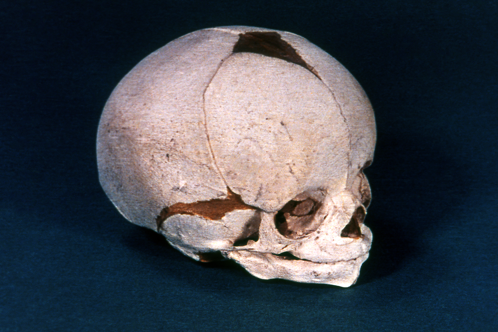 Cráneo de un feto casi formado