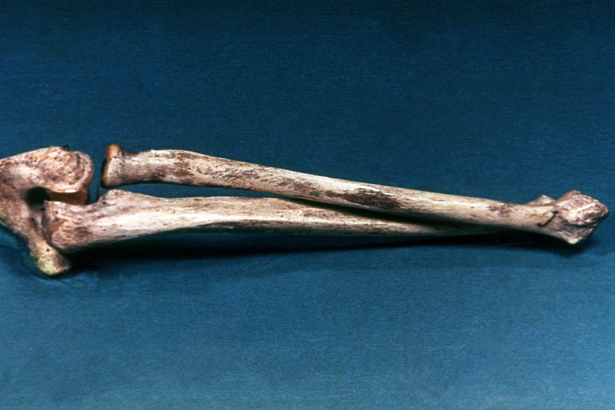 Articulación del antebrazo