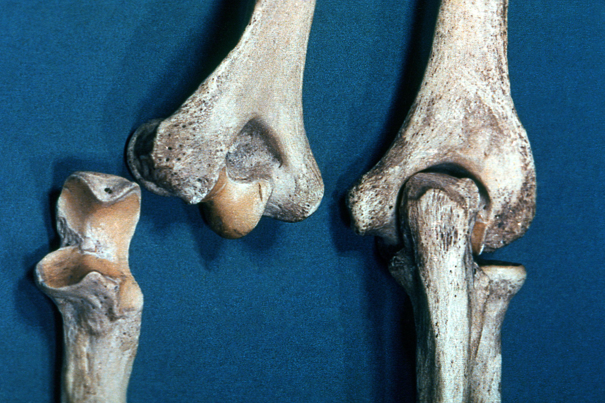 Articulación del codo