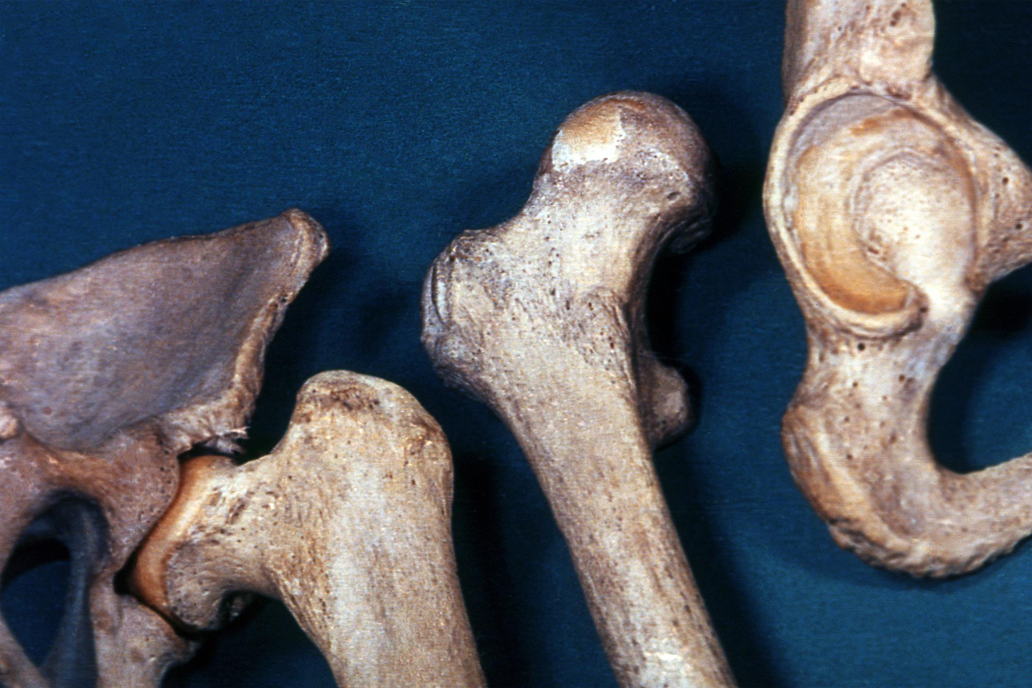 Articulación de la cadera (coxofemoral)
