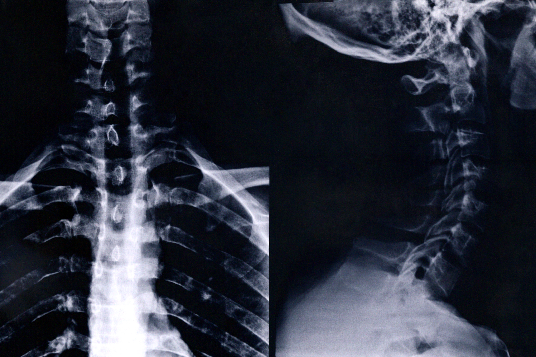 Radiografía de la columna cervical
