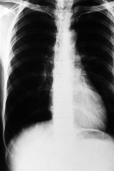 Radiografía de la caja torácica
